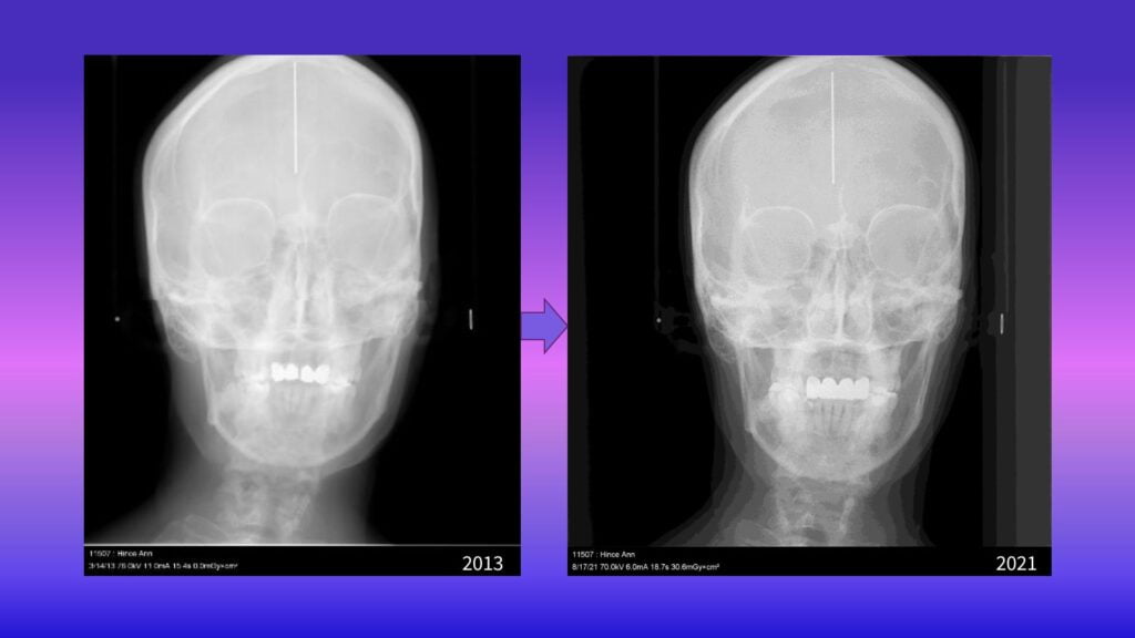 Ann Hince X-ray - 2013-2021